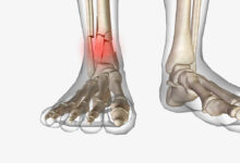 Ortopedia Goiânia - Quais os tratamentos para fratura do tornozelo