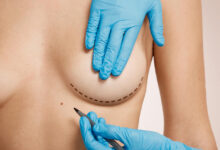 Cirurgia Plástica Goiânia - 4 principais opções de cirurgia plástica de mama
