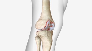 Ortopedia Goiânia - Diferença entre a lesão da cartilagem do joelho e artrose do joelho