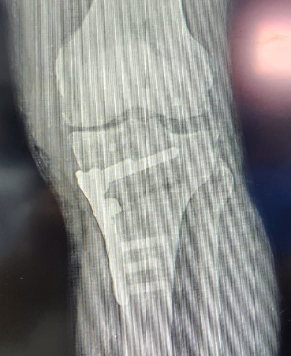Ortopedia Goiânia - Quando a cirurgia de osteotomia de joelho é indicada 1