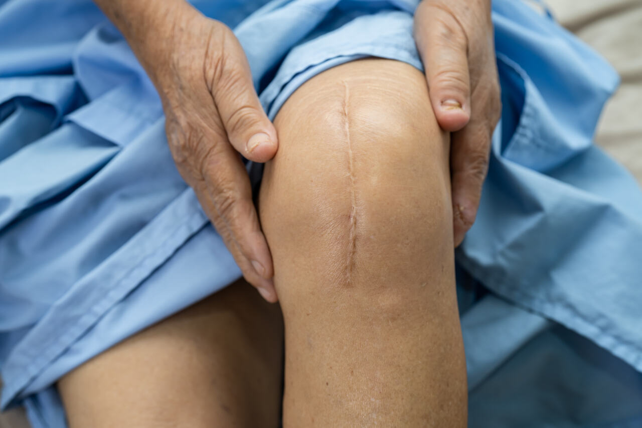 Quais são os riscos de uma cirurgia de prótese de joelho